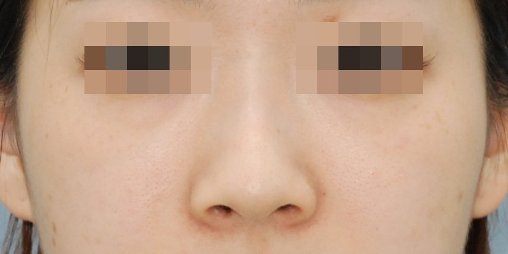 메부리+실리콘+코끝(자가연골) — 수술 전 사진