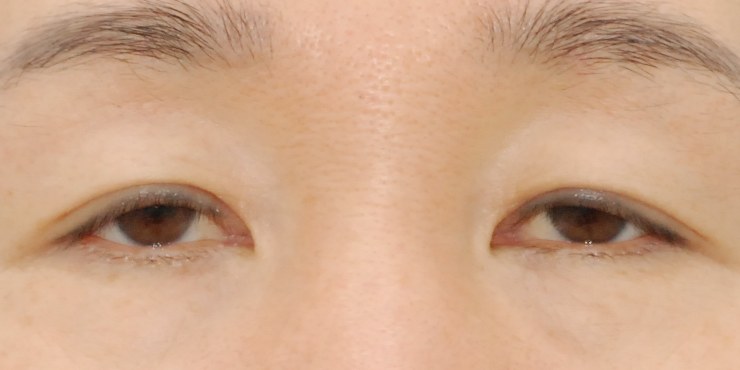 눈썹하거상 — 수술 전 사진