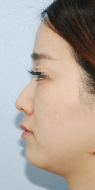 메부리 교정 측면라인 — 수술 전 사진
