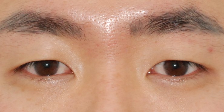 절개+눈매교정 — 수술 전 사진