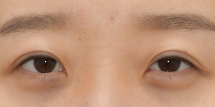 절개재수술+절개눈매교정 — 수술 전 사진